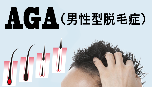 AGA（男性型脱毛症）